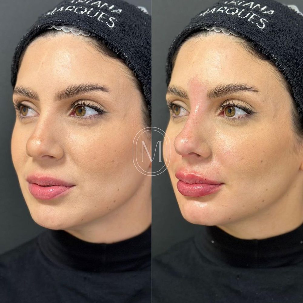 labial-1