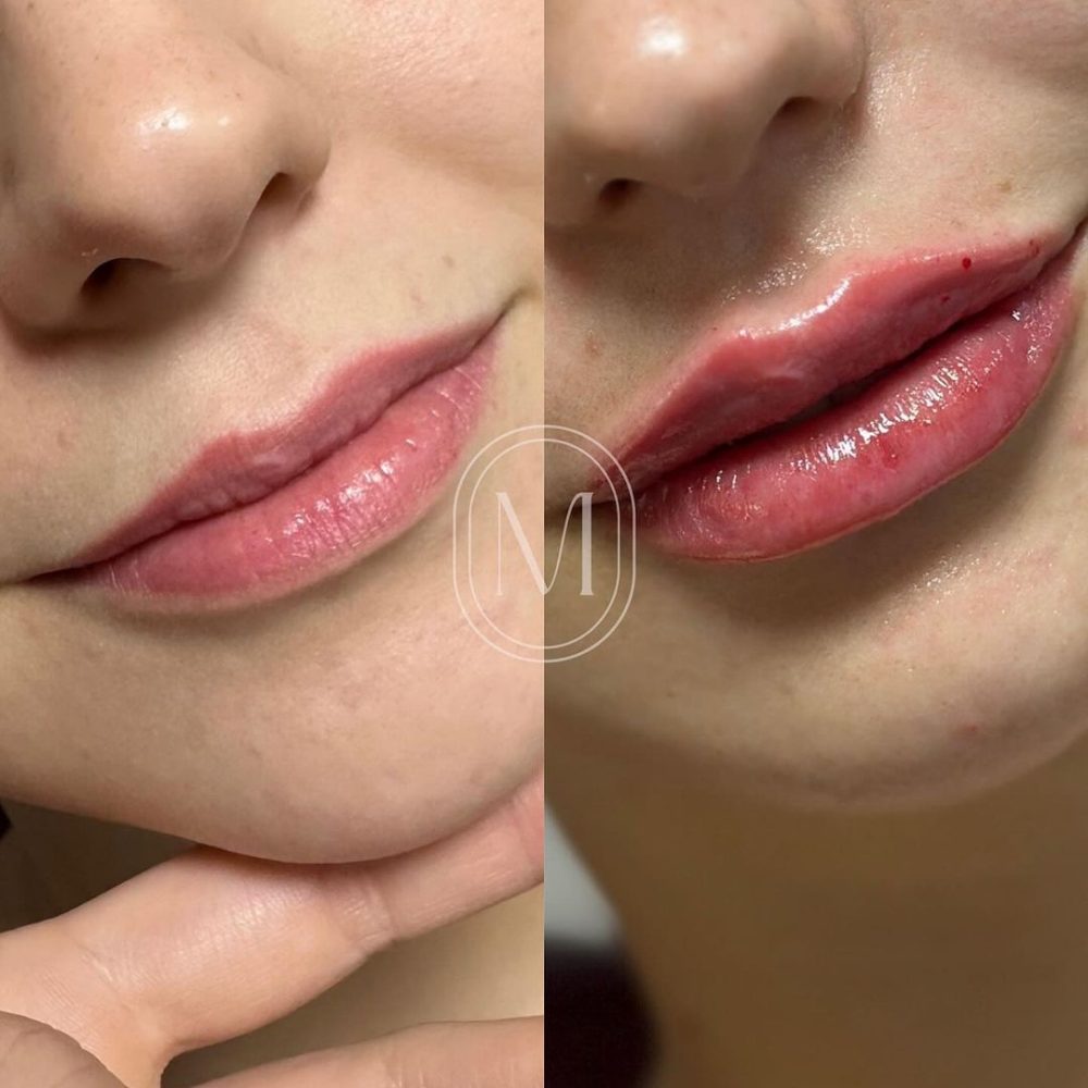 labial-2