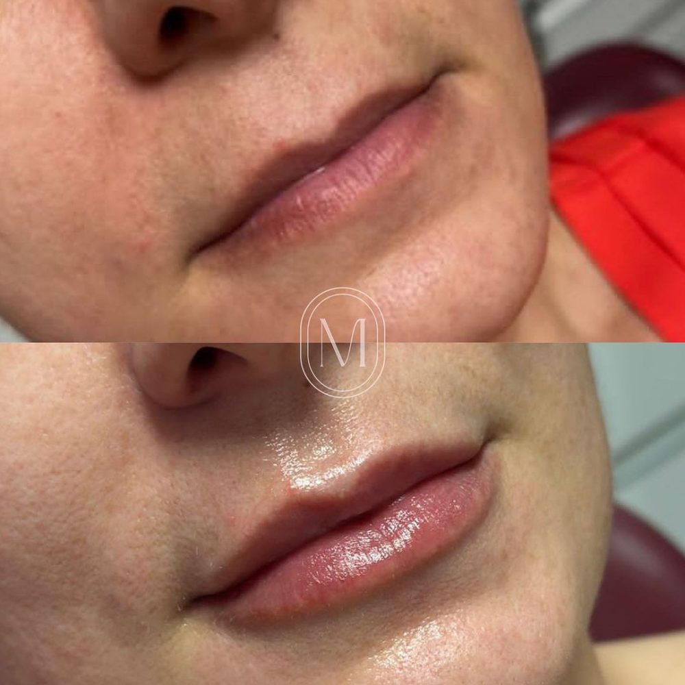 labial-4