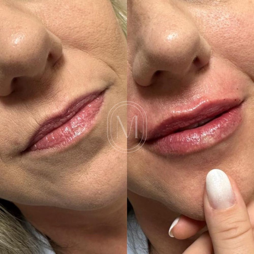 labial